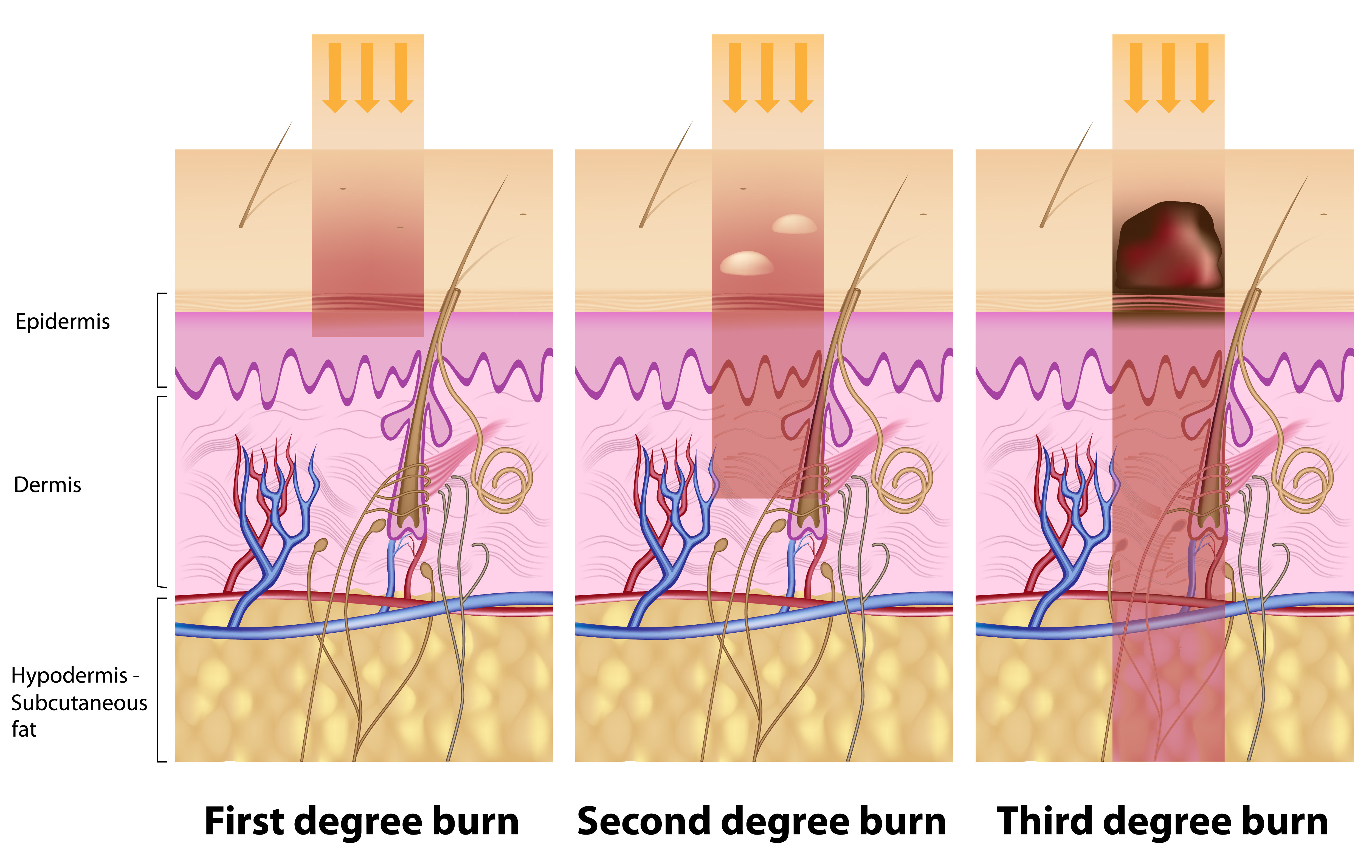 Different Types Of Burns And Treatment Urgent Medical Care