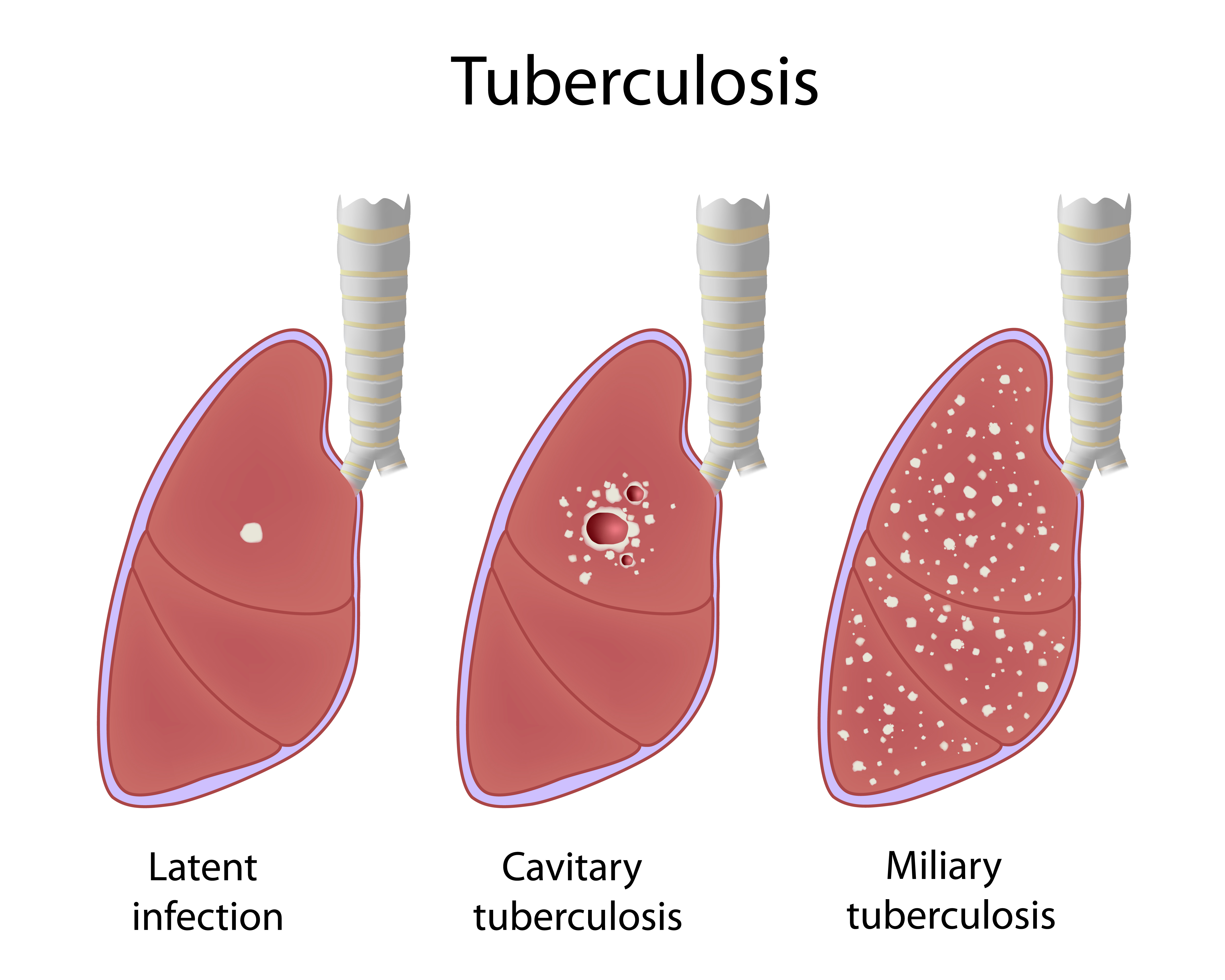 latent tuberculosis contagious