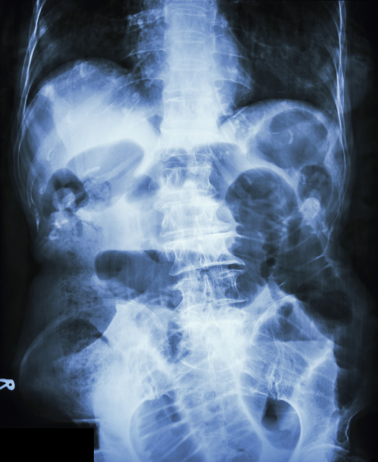 What Is An Intestinal Obstruction 